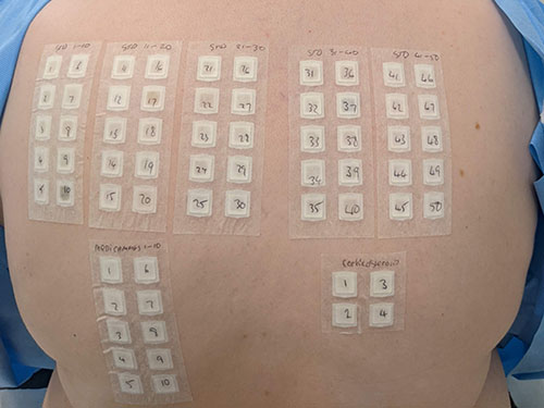 patch testing on someones back