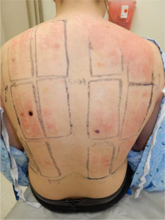 allergy testing on man's back