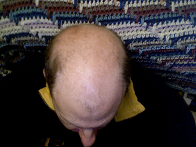 man with male pattern baldness