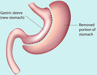 Illustration explaining gastric sleeve surgery