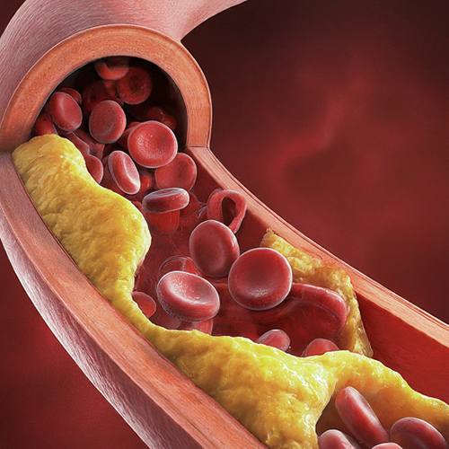 artery showing cholesterol growth