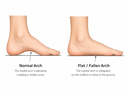 Side-view diagram showing flat feet symptoms in adults comparing a normal foot arch with a flat foot showing fallen arch.